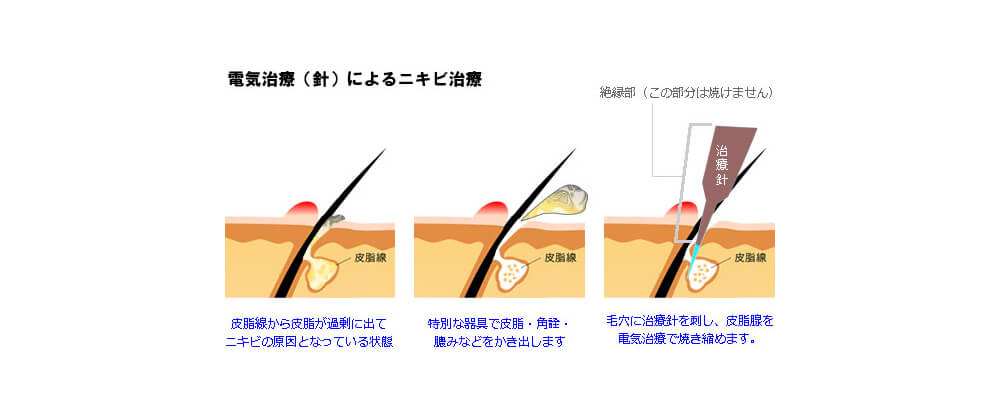 がんこな毛穴や症状が良くない場合の治療法