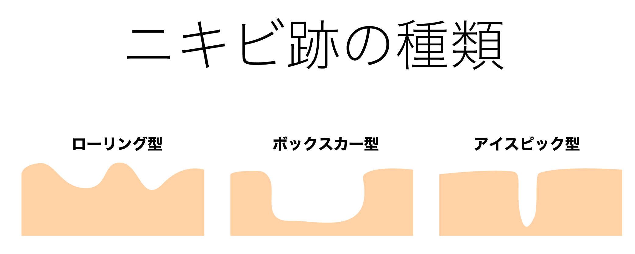 フラクショナル炭酸ガスレーザー