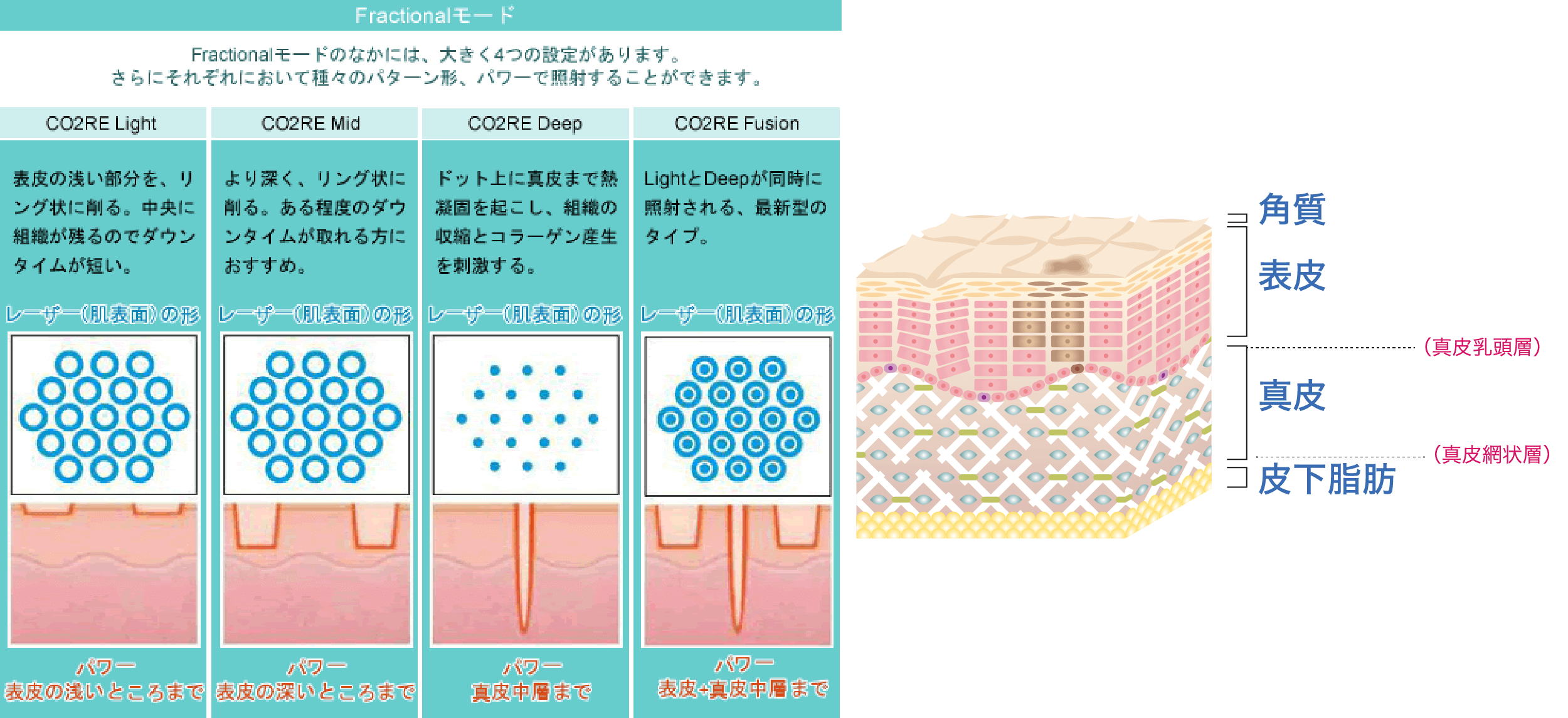 フラクショナル炭酸ガスレーザー