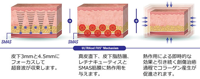 ウルトラセル（ウルセラ）高密度焦点式超音波（HIFU）を用いた治療　FUS