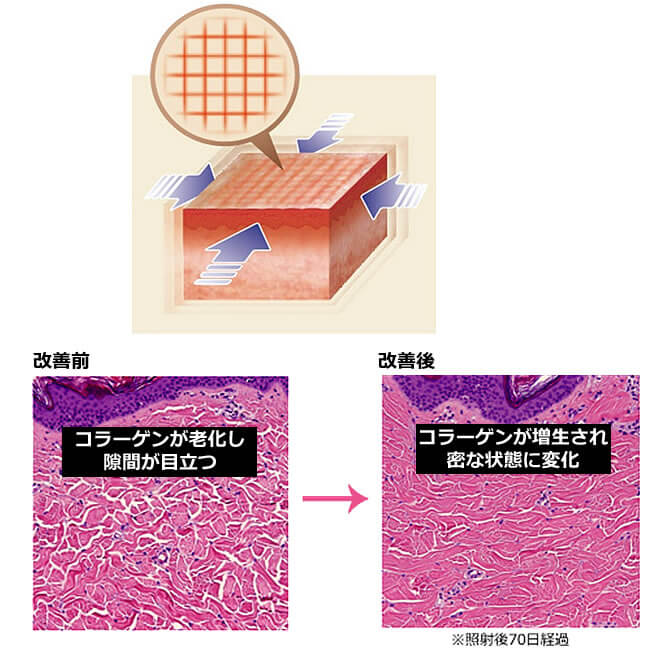 ウルトラセル（ウルセラ）高周波（RF）を用いた治療　GFR